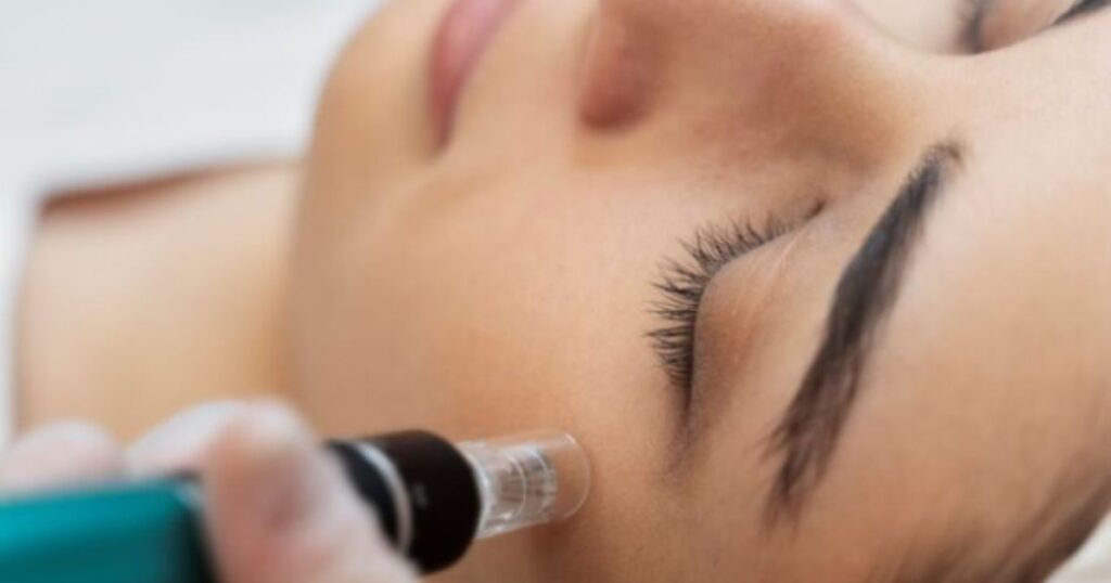 Skin needling