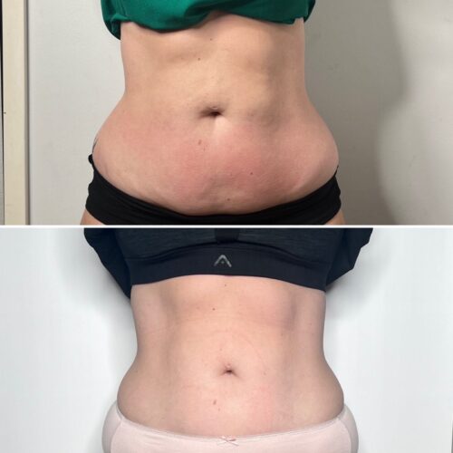 5 X EMS/FAT Cavitation/RF Vacuum