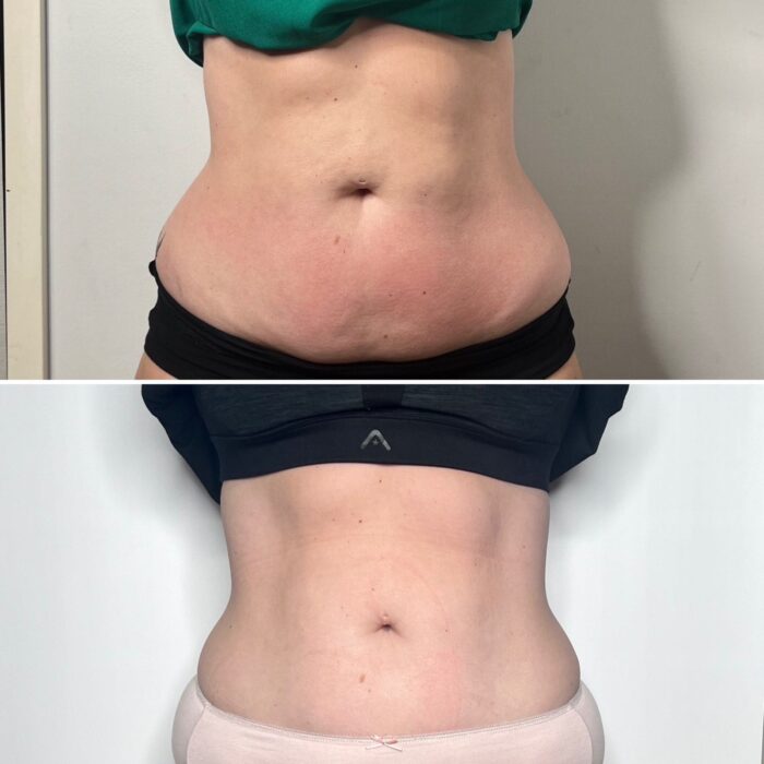 5 X EMS/FAT Cavitation/RF Vacuum